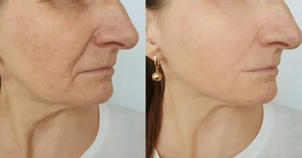 Antes e depois do uso do sérum Aglaia