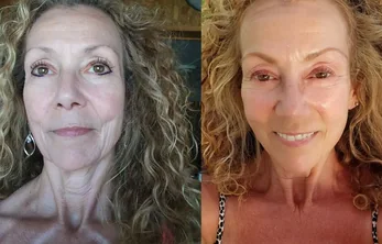 Antes e depois do uso do sérum Aglaia